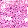 10A3-Spinal-Muscular-Atrophy-Case-10-H-E-4.jpg