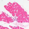 1A1 Muscle, Atrophy (Case 1) H&E 10X