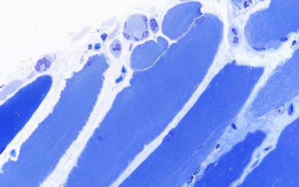 3B1 Atrophy (Case 3) 60X