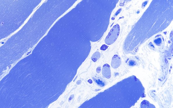 3B2 Atrophy (Case 3) 60X 2