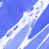3B3 Atrophy (Case 3) 60X 3