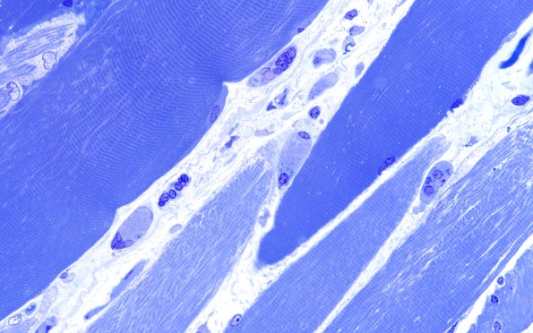 3B3 Atrophy (Case 3) 60X 3