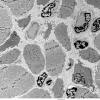 4A1Atrophy, muscle, marked (Case 4) EM 005 - Copy