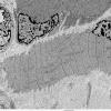 4A3A Atrophy (Case 4) EM 015 - Copy