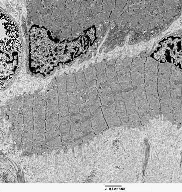 4A3A Atrophy (Case 4) EM 015 - Copy