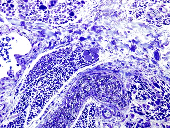 6A Atrophy, muscle (Case 6)