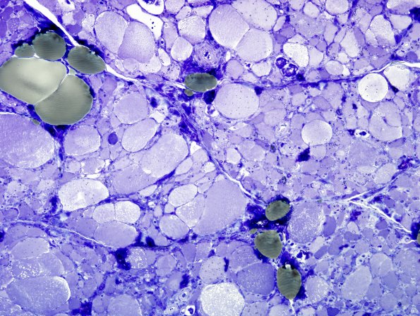 7A2Muscle, denervation atrophy (Case 7) Plastic 2