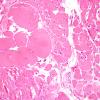9A2-Muscle-Fiber-Atrophy-Hypertrophy-Case-9-H-E-4.jpg