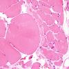 9A3-Muscle-Fiber-Atrophy-Hypertrophy-Case-9-H-E-3.jpg