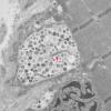 11S4D HCG (Case 11) EM 019 - Copy copy