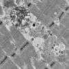 11T11A HCG (Case 11) EM 049 - Copy
