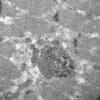11T12B HCG (Case 11) EM 056 - Copy