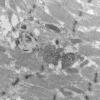 11T12D HCG (Case 11) EM 059 - Copy