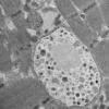 11T2A HCG (Case 11) EM 030 - Copy