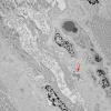 11T4A HCG (Case 11) EM 014 copy - Copy