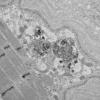 11T4B HCG (Case 11) EM 015 - Copy