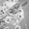 11T5B HCG (Case 11) EM 008 - Copy