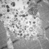 11T6B HCG (Case 11) EM 004 - Copy