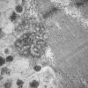 11T6C HCG (Case 11) EM 005 - Copy