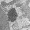 11T7B HCG (Case 11) EM 039 - Copy