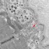 11T8 HCG (Case 11) EM 040 copy - Copy