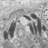 11U1A HCG (Case 11) EM 046 - Copy
