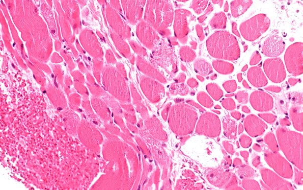 2A1 Autophagic Myopathy (Case 2) H&E 40X 3
