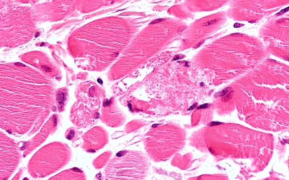 2A2Autophagic Myopathy (Case 2) H&E 60X