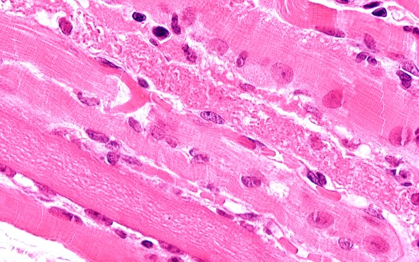 2A3 Autophagic Myopathy (Case 2) H&E 100X 1