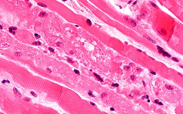 2A4 Autophagic Myopathy (Case 2) H&E 100X 3