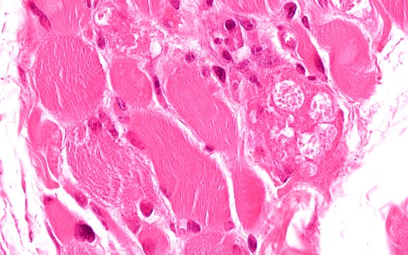 2A5Autophagic Myopathy (Case 2) H&E 100X 4