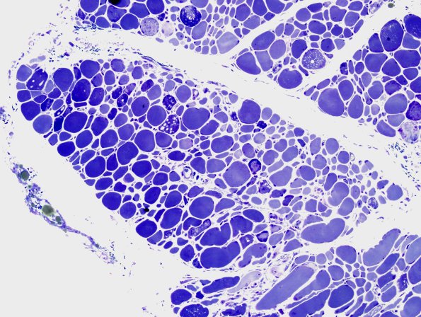 2B1A Autophagic Myopathy (Case 2) Plastic 3