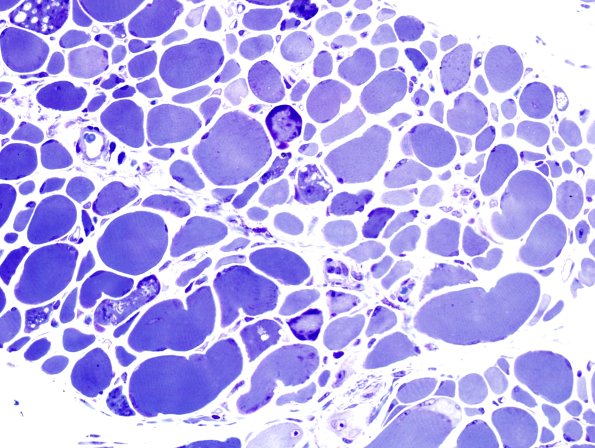 2B1B Autophagic Myopathy (Case 2) Plastic 2