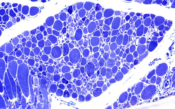 2B2 Autophagic Myopathy (Case 2) Plastic 20X 1
