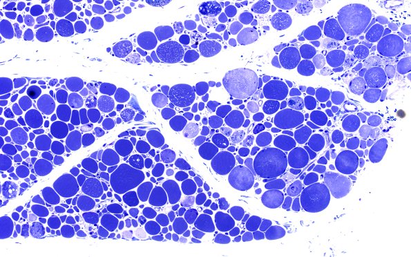 2B3 Autophagic Myopathy (Case 2) Plastic 20X 2