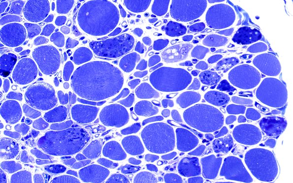 2B4A Autophagic Myopathy (Case 2) Plastic 40X 1
