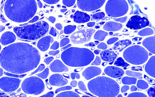 2B4B Autophagic Myopathy (Case 2) Plastic 60X 1