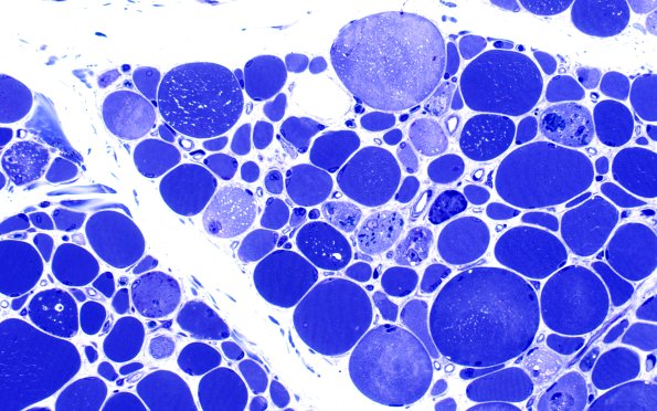 2B5 Autophagic Myopathy (Case 2) Plastic 40X 2