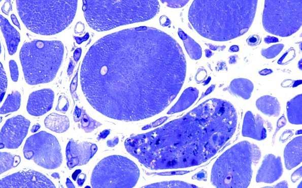 2B6 Autophagic Myopathy (Case 2) Plastic 100X 2
