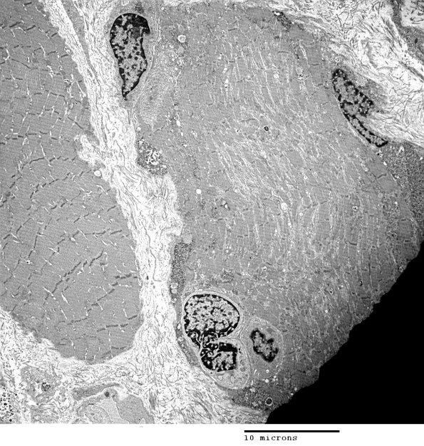 2C1A Autophagic Myopathy (Case 2)_027 - Copy