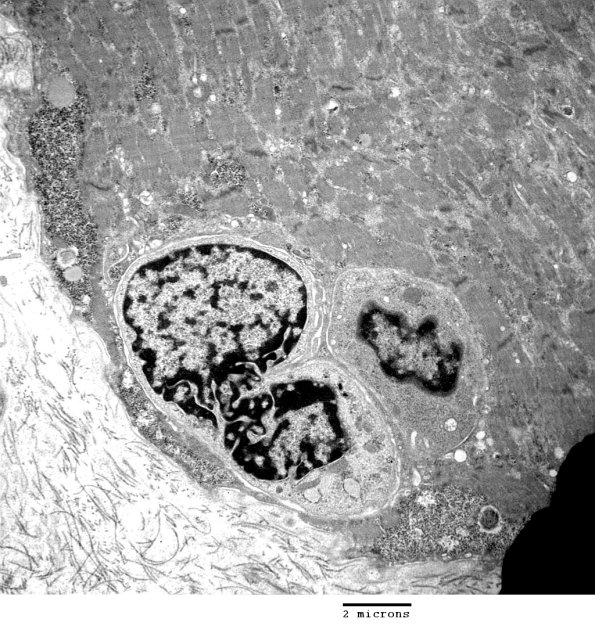 2C1BAutophagic Myopathy (Case 2)_028 - Copy