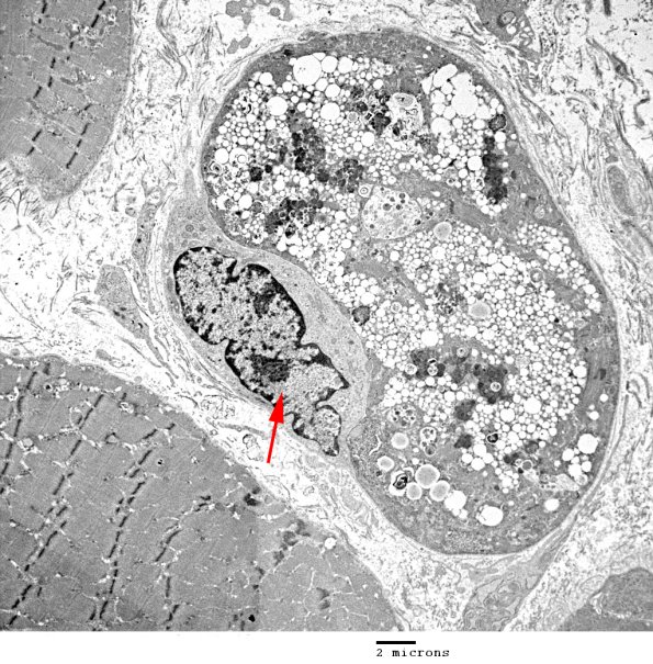 2C2A CAutophagic Myopathy (Case 2)_055 - Copy copy