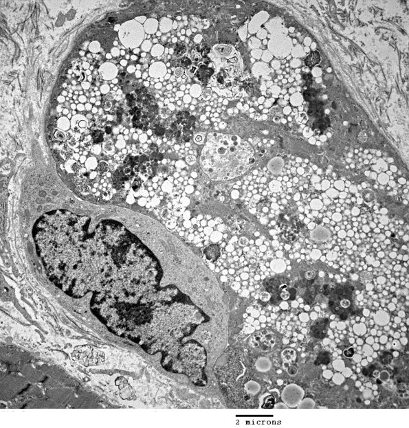 2C2B Autophagic Myopathy (Case 2)_056 - Copy