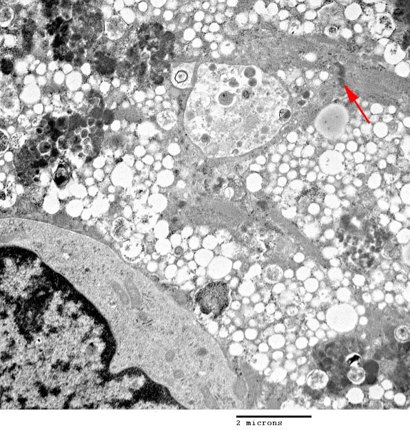 2C2C Autophagic Myopathy (Case 2)_057 - Copy copy