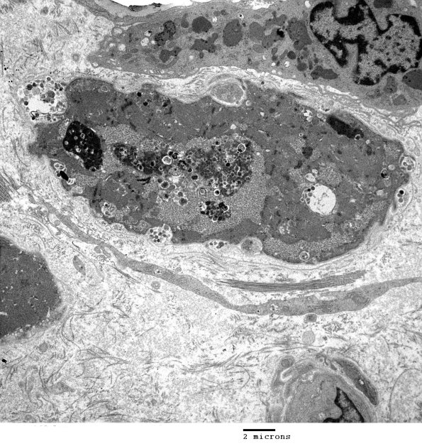 2C3A Autophagic Myopathy (Case 2)_044 - Copy