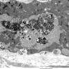 2C3B Autophagic Myopathy (Case 2)_045 - Copy