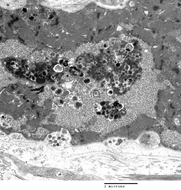 2C3B Autophagic Myopathy (Case 2)_045 - Copy