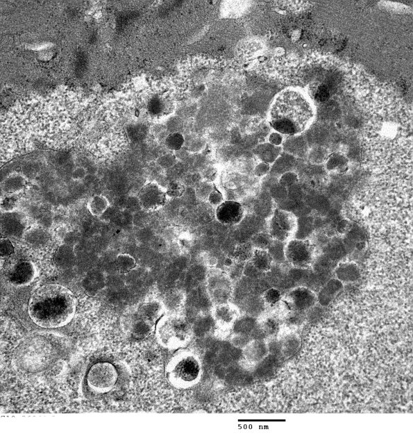 2C3C Autophagic Myopathy (Case 2)_046 - Copy