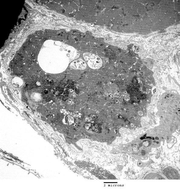 2C4A Autophagic Myopathy (Case 2)_033 - Copy