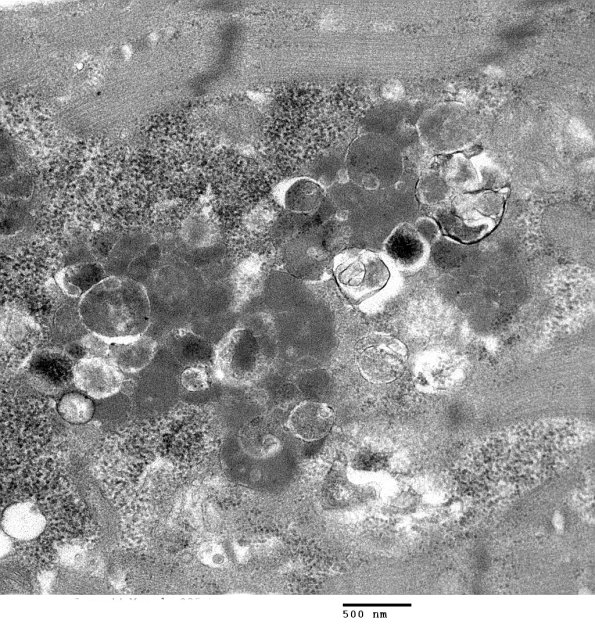 2C4B Autophagic Myopathy (Case 2)_035 - Copy